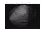 tumor_image